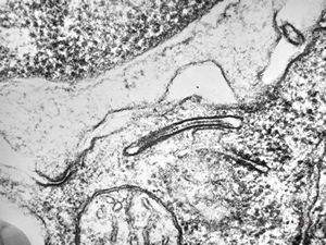 M, 7m. | histiocytosis X (eosinophilic granuloma) - Birbeck body